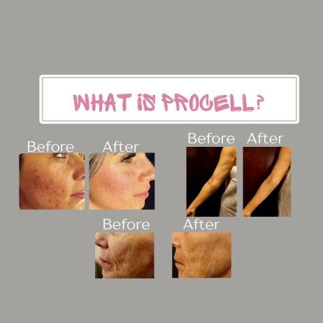 Pro Cell is an innovative skincare treatment that harnesses the body's natural regenerative abilities to rejuvenate the skin. Unlike traditional methods that may rely on harsh or inflammatory techniques, Pro Cell works by stimulating the skin's cellu