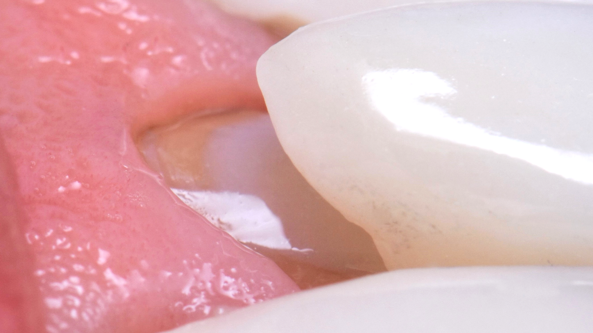 La DENT en 2026 – Du composite … à la Vertiprep