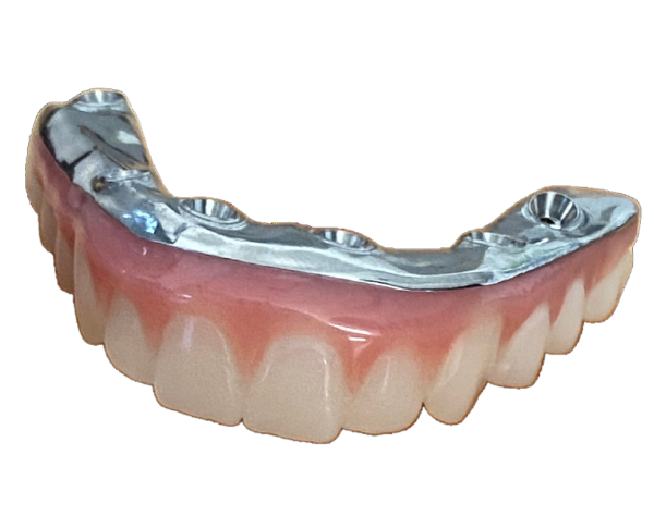 Implant-supported denture with metal bar attachment for upper jaw