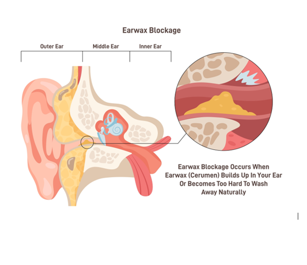 Microsuction — Clear Ear Health