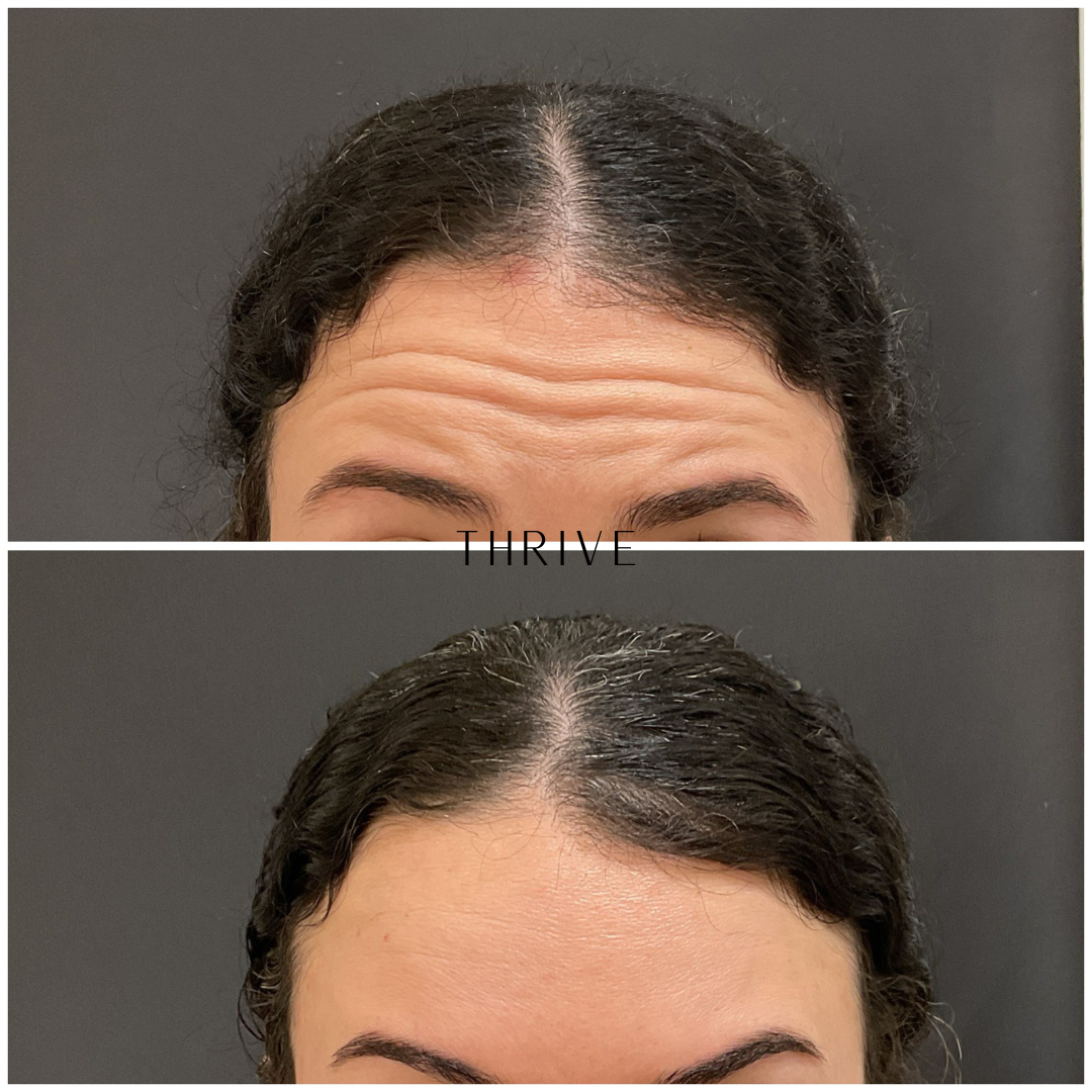 What Is Botox and Why People Love It: Your In-Depth Guide — Thrive ...