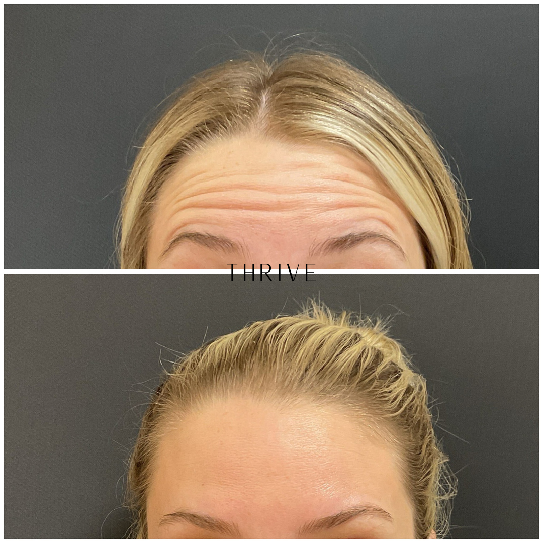 A before and after visual of a Thrive Medical Spa client receiving Dysport treatment