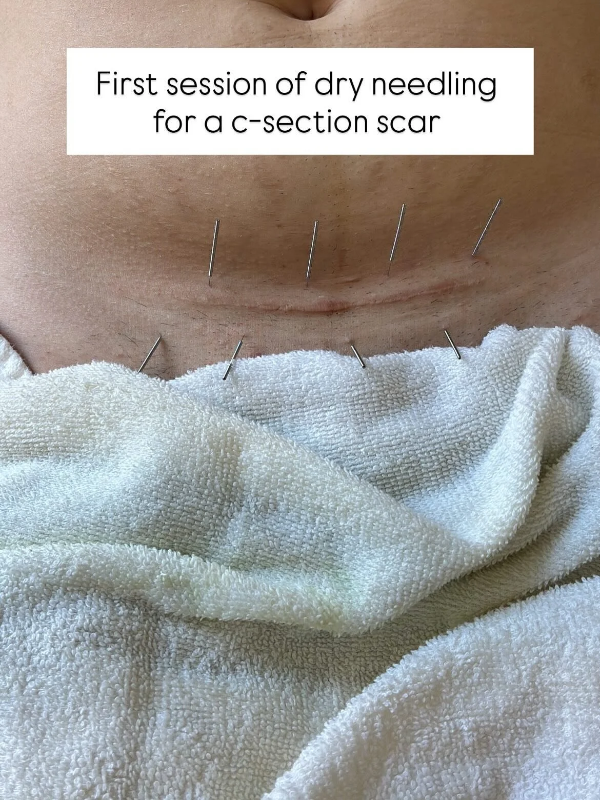 Did you know S&oacute;L offers dry needling as an additional treatment tool?!?! Dry needling uses the same needles as acupuncture but I am putting the needles into areas of muscle or nerve dysfunction. There has been some amazing success happening in