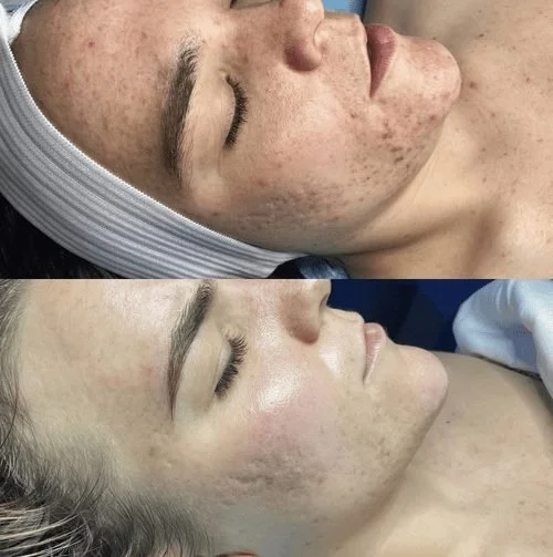 Side-by-side comparison of a woman's face before and after a skincare treatment, showing improvement in skin clarity and texture.