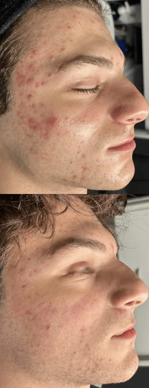 Close-up of a young man's face with red acne and pimples on forehead, cheek, and chin.