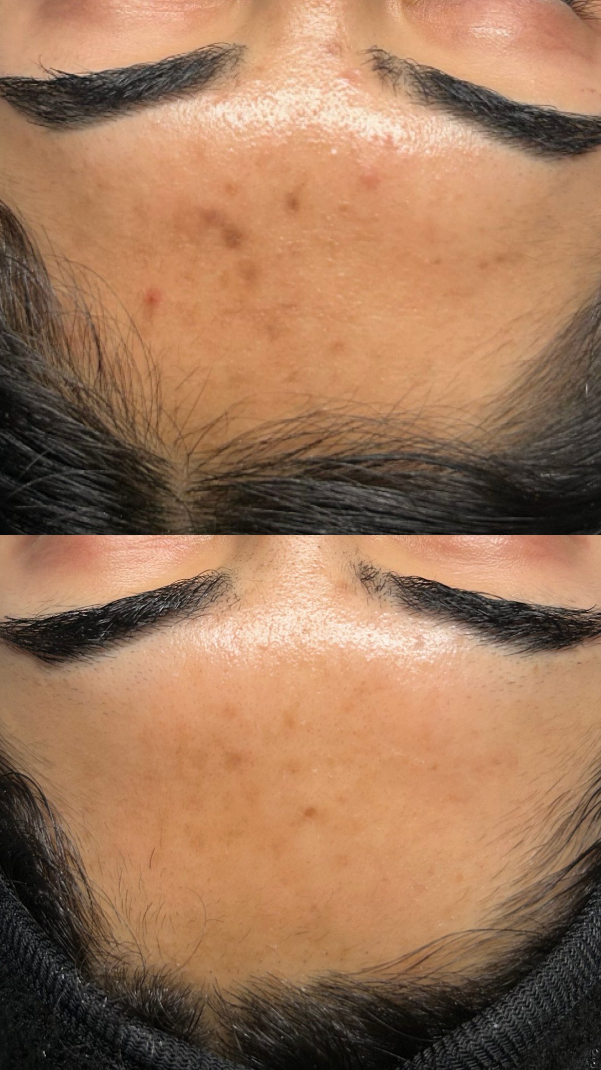 What’s the Best Facial for Acne-Prone Skin? | San Diego Skincare Experts Weigh In