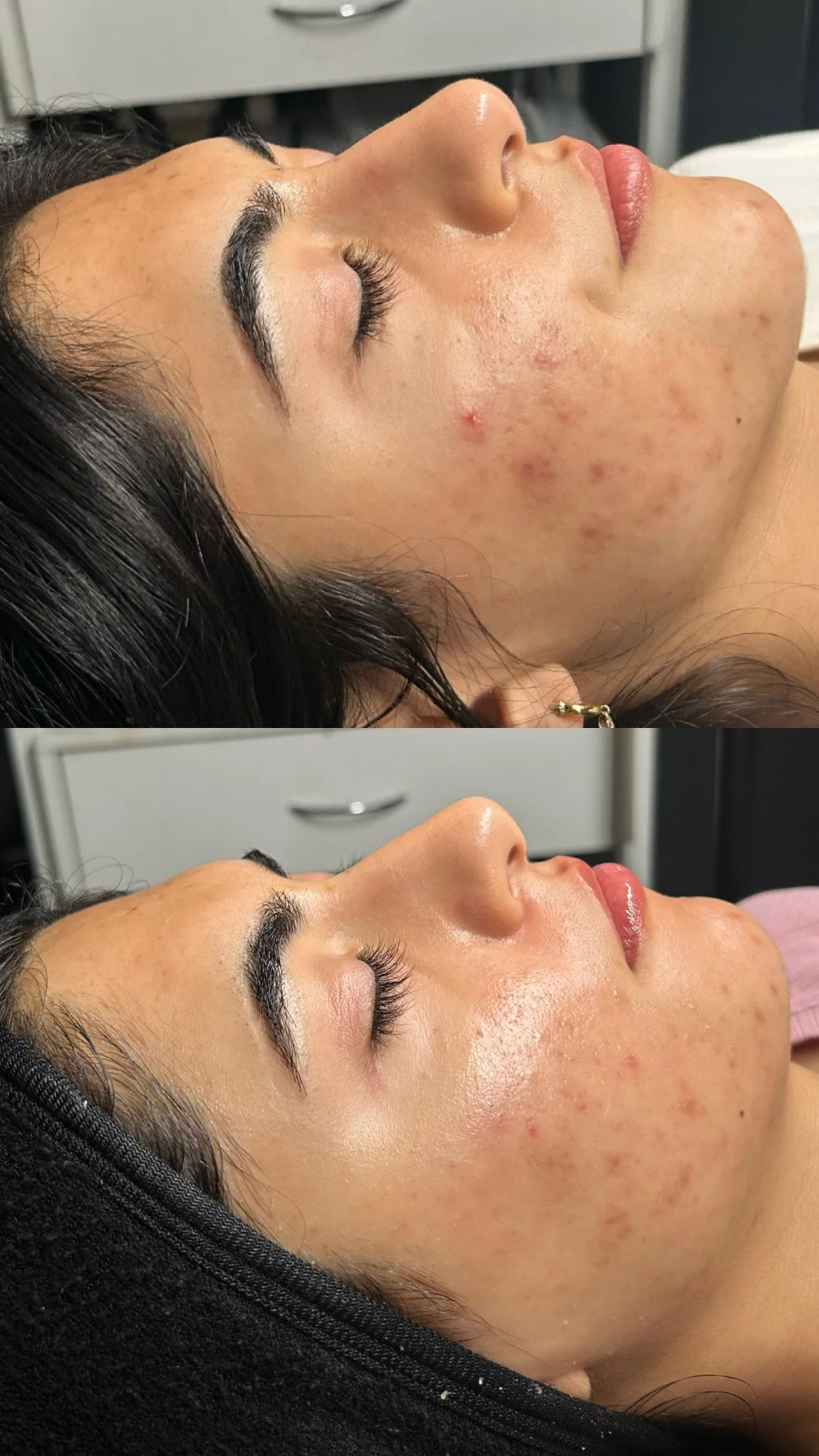 Acne Awareness Month: Why One Facial Isn't Enough for Clear Skin