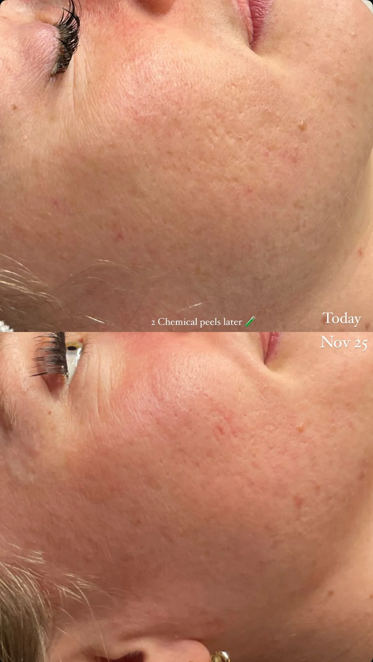 The Best Chemical Peel for Melasma &amp; Hyperpigmentation in San Diego: Everything You Need to Know