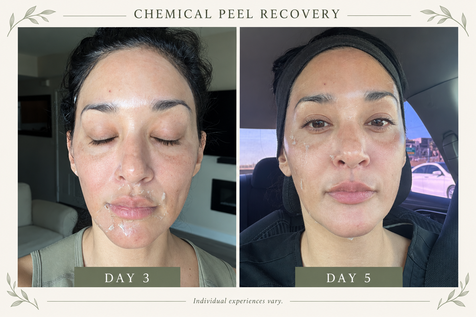 Best Time for a Chemical Peel in San Diego