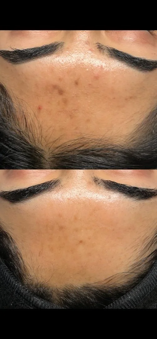 Close-up of a person's forehead showing before and after images of skincare treatment, highlighting reduced dark spots and blemishes.