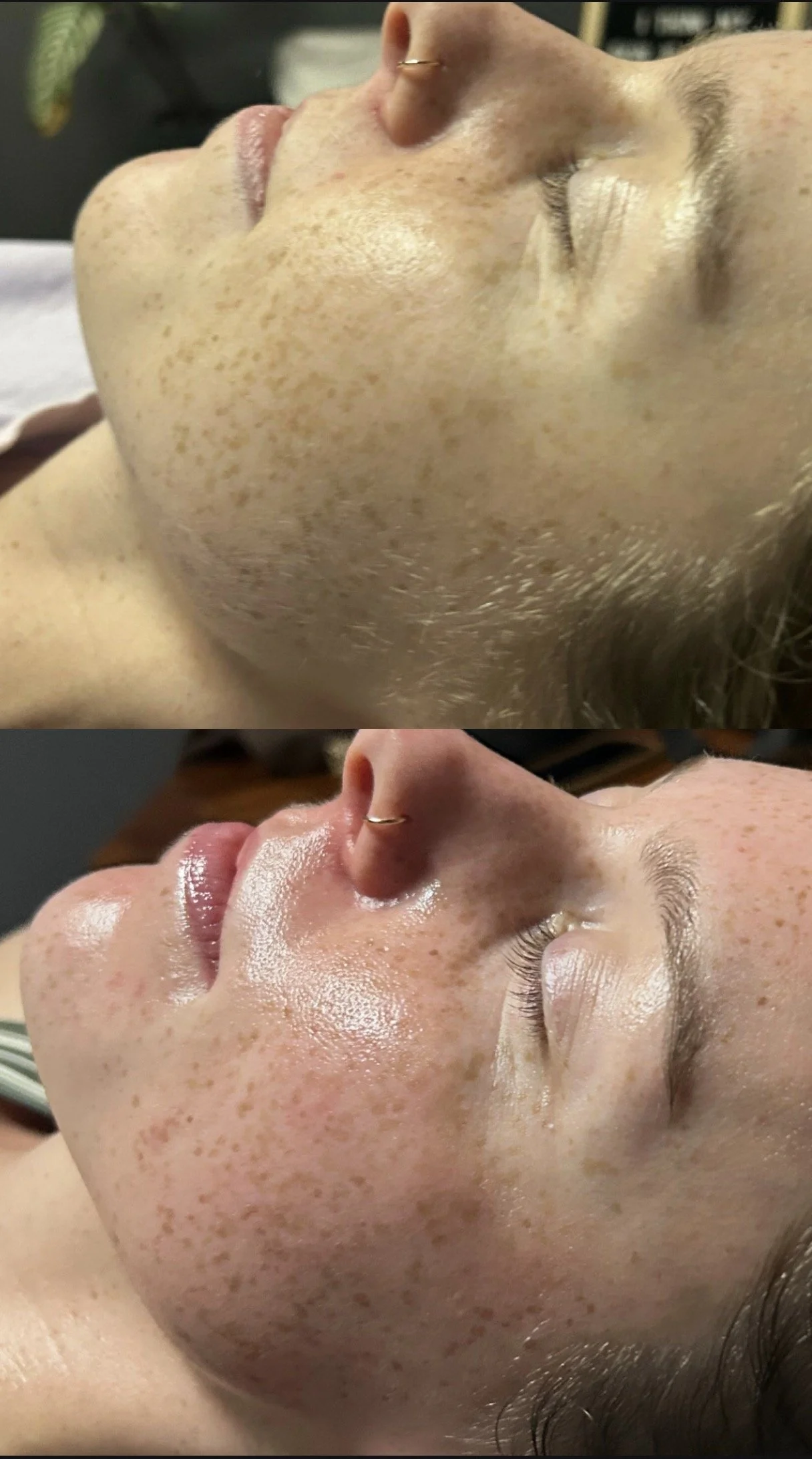 Close-up side view of a woman's face before and after a facial treatment, highlighting the reduction in freckles and skin redness.