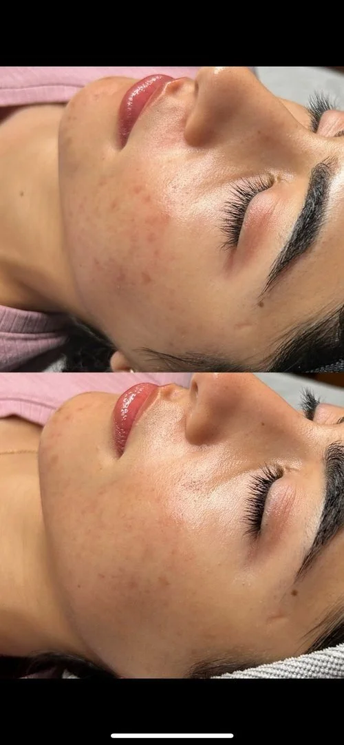Close-up of a woman's face showing before and after skincare treatment, with improved skin texture and reduced redness.