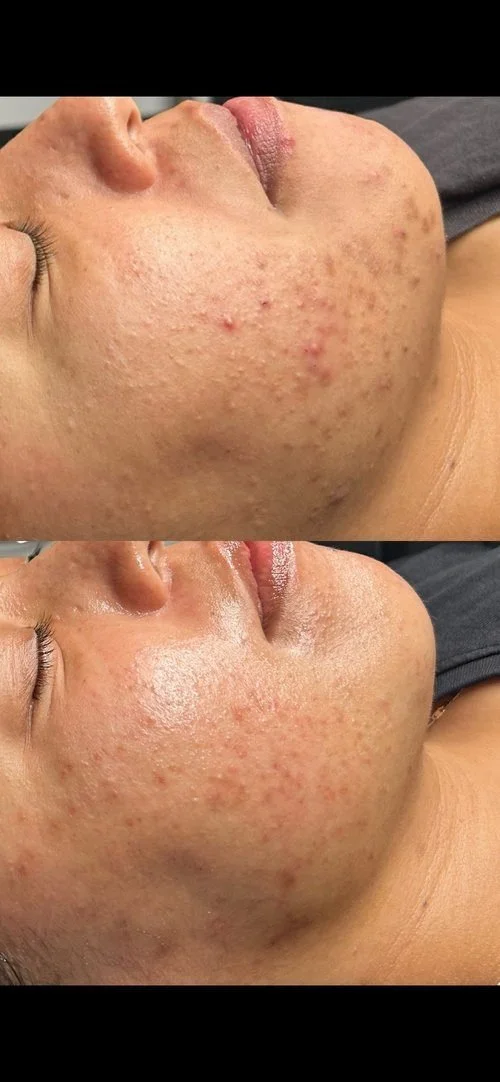 Close-up of a person's face showing skin before and after a skincare treatment, with visible reduction in acne scars and blemishes.