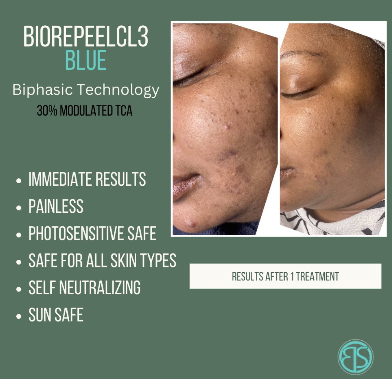 Before and after images showing improved skin texture on a person's face after one treatment with Biorepeel C3 Blue, emphasizing clearer skin free of acne scars and hyperpigmentation.
