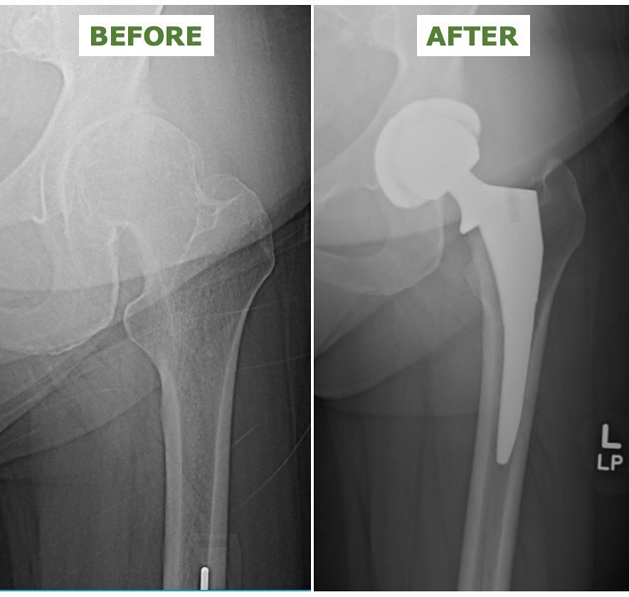 Total hip replacement (anterior approach)

Not pictured: wound management for a patient with obesity (BMI 40). For patients at high risk, we often use a prophylactic incisional wound vac.  Extended prophylactic antibiotics, while controversial, are a