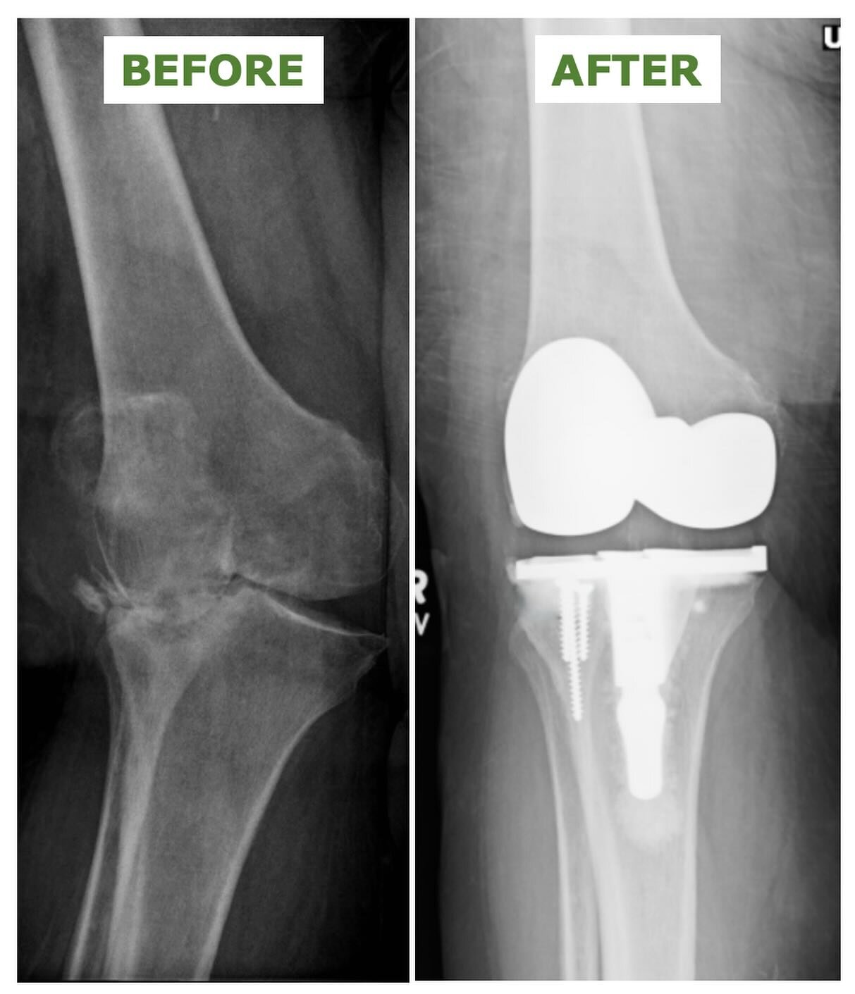Total knee replacement

This was a patient who presented with bone loss due to severe knee osteoarthritis and a substantial angular deformity.  After standard preparation there was a bone defect.  Here we were able to address this with a &ldquo;rebar
