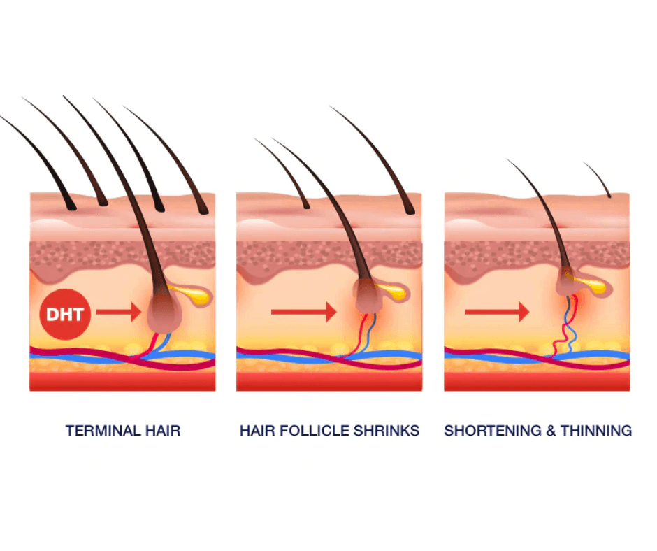 Diagram showing the process of hair shrinking and thinning: terminal hair on the scalp, hair follicle shrinking, and hair shortening and thinning.