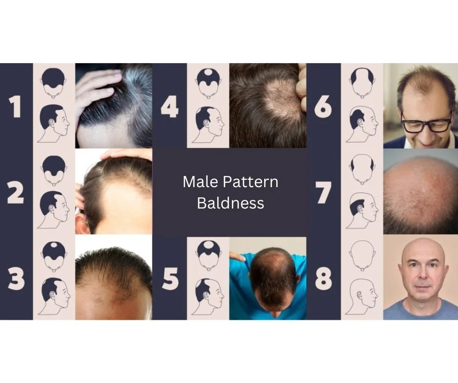 A chart illustrating male pattern baldness with photos of men at different stages of hair loss, including receding hairlines and bald crowns, accompanied by diagrams showing hair loss patterns.
