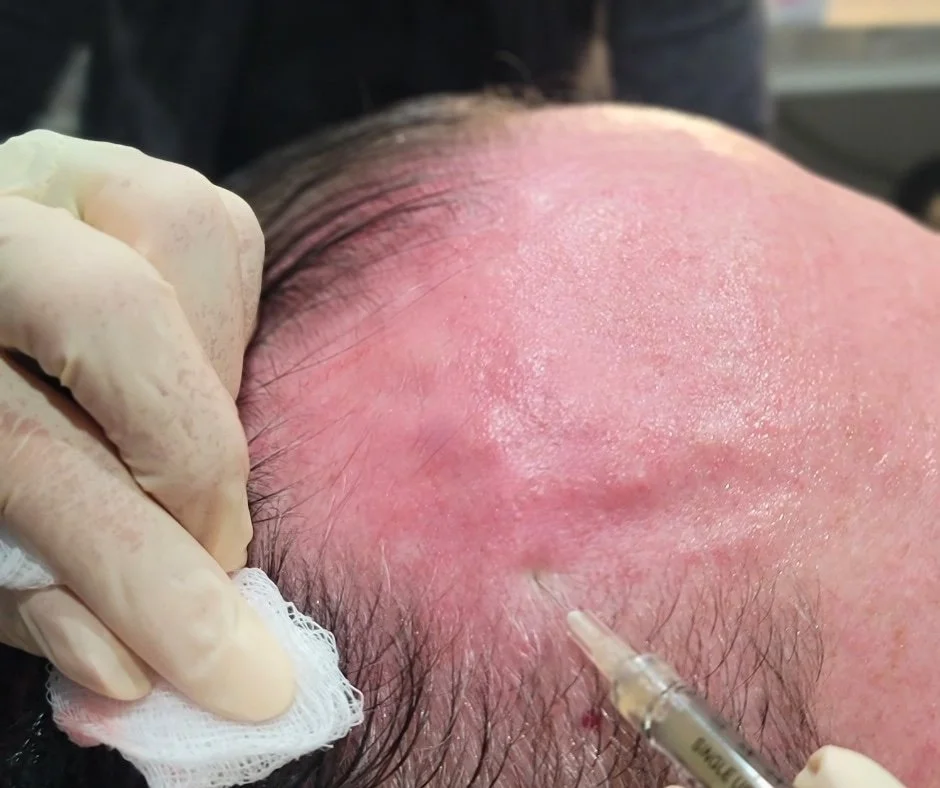 A person receiving a cosmetic injection into their forehead while lying down, with a gloved hand holding a syringe and a cotton pad, showing a close-up of the forehead and scalp.