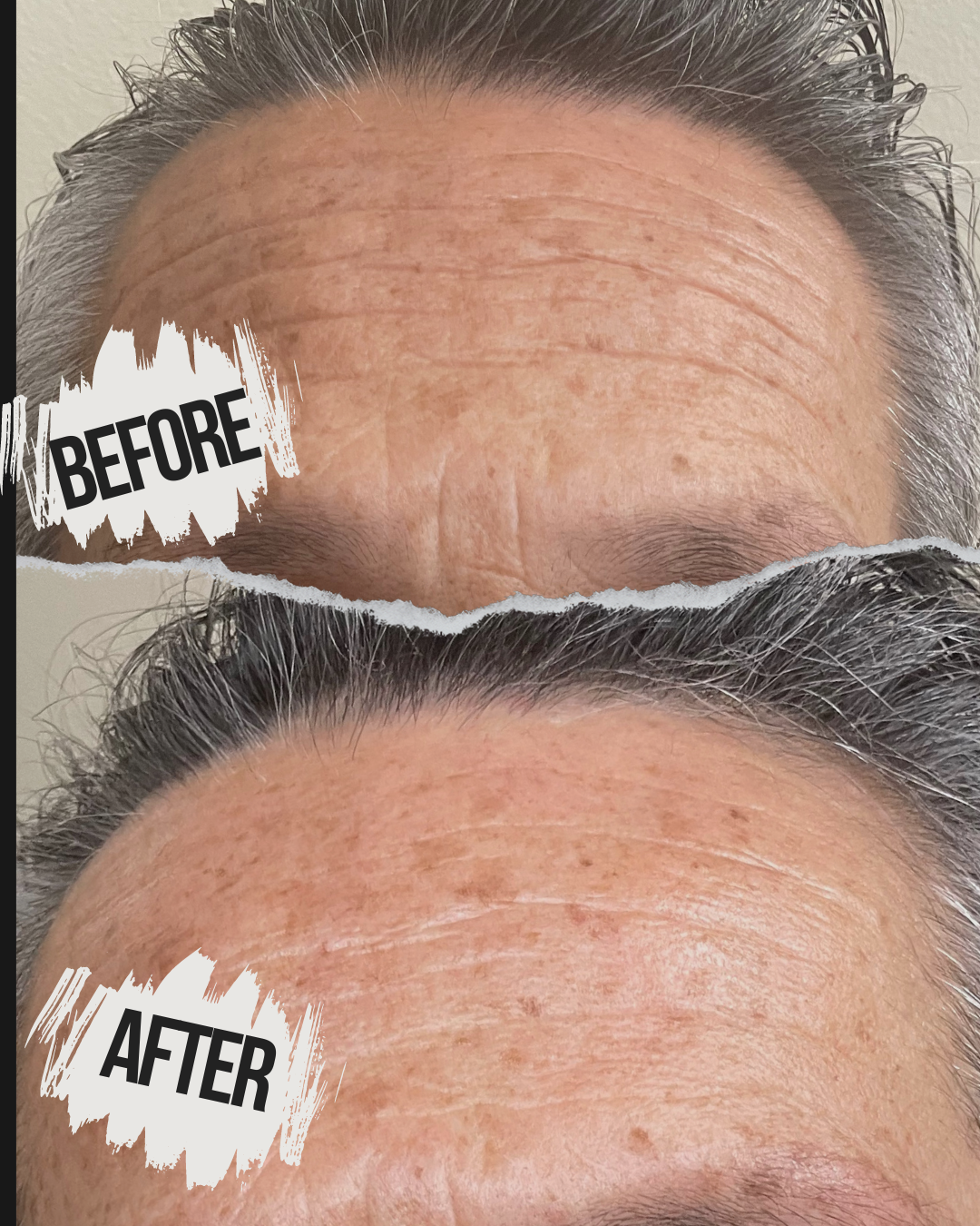 Microdermabrasion, 1 session