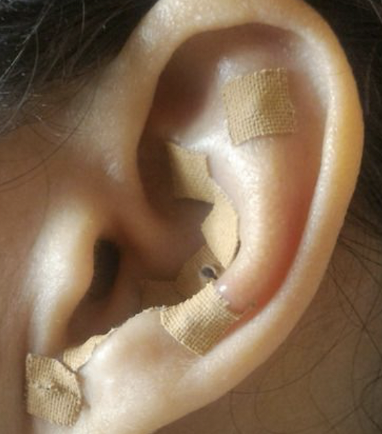 Close-up of an ear with multiple small bandages applied on different areas.