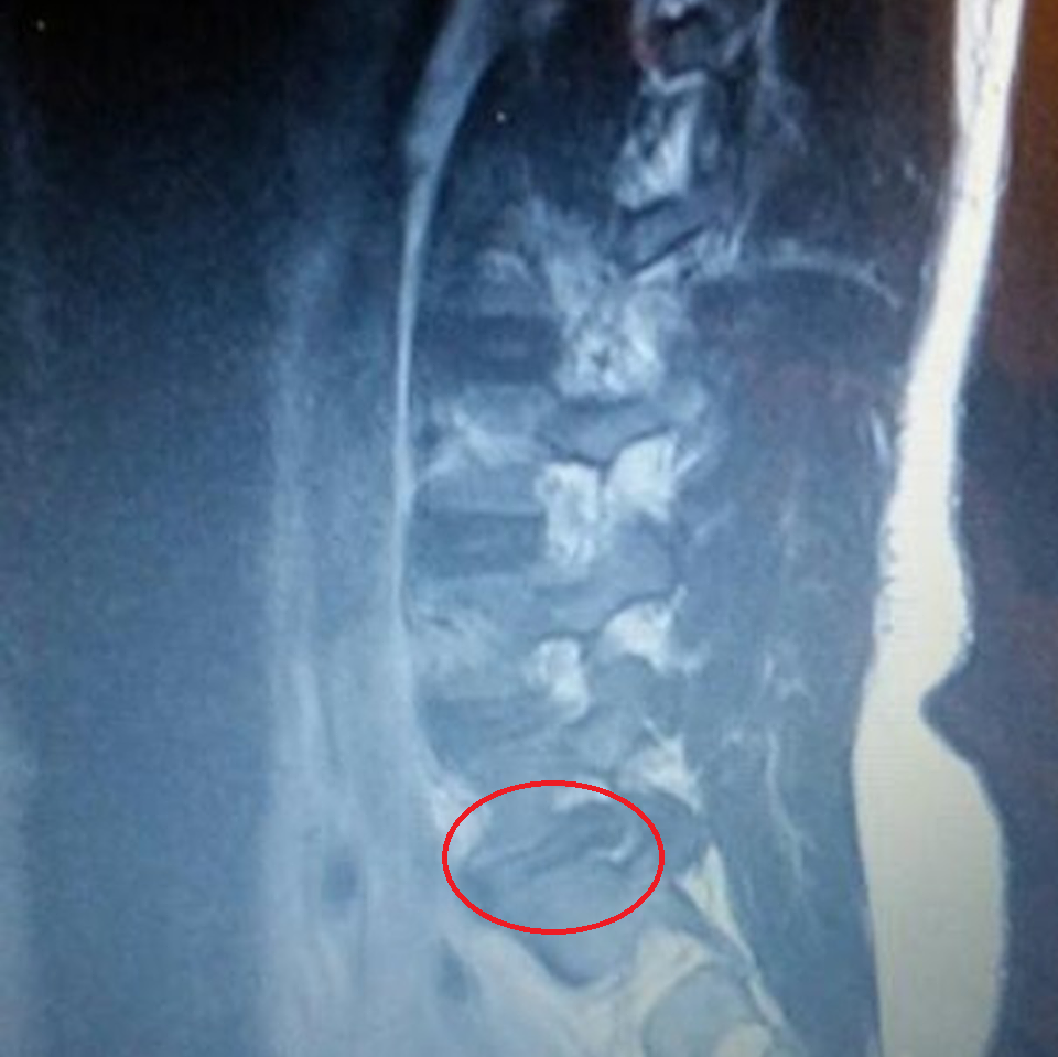 A Wrestler's Experience with Herniated Disc Surgery — LuchaFit