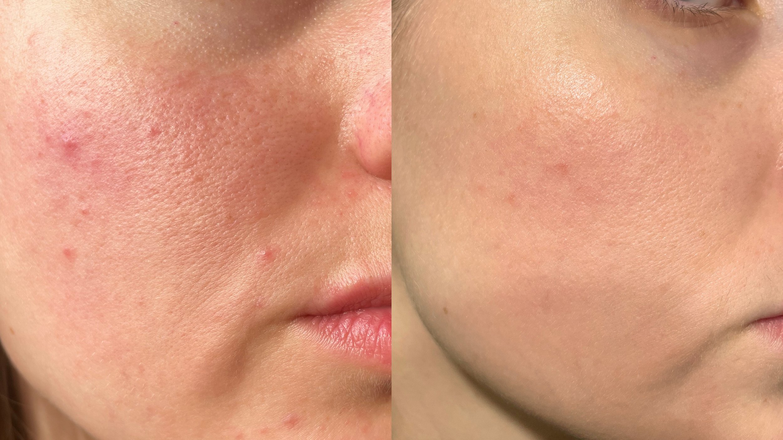 Minimise acne scars for clearer skin.