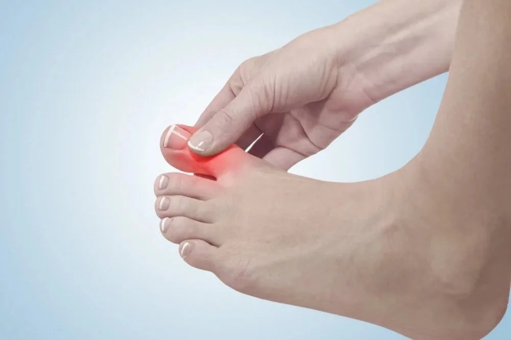 Podiatrist Tips for Prevention of Gout Flare Ups - Leading Podiatrist serving Rosedale,Woodmere, Inwood, Lawrence, Cedarhurst & Hewlett