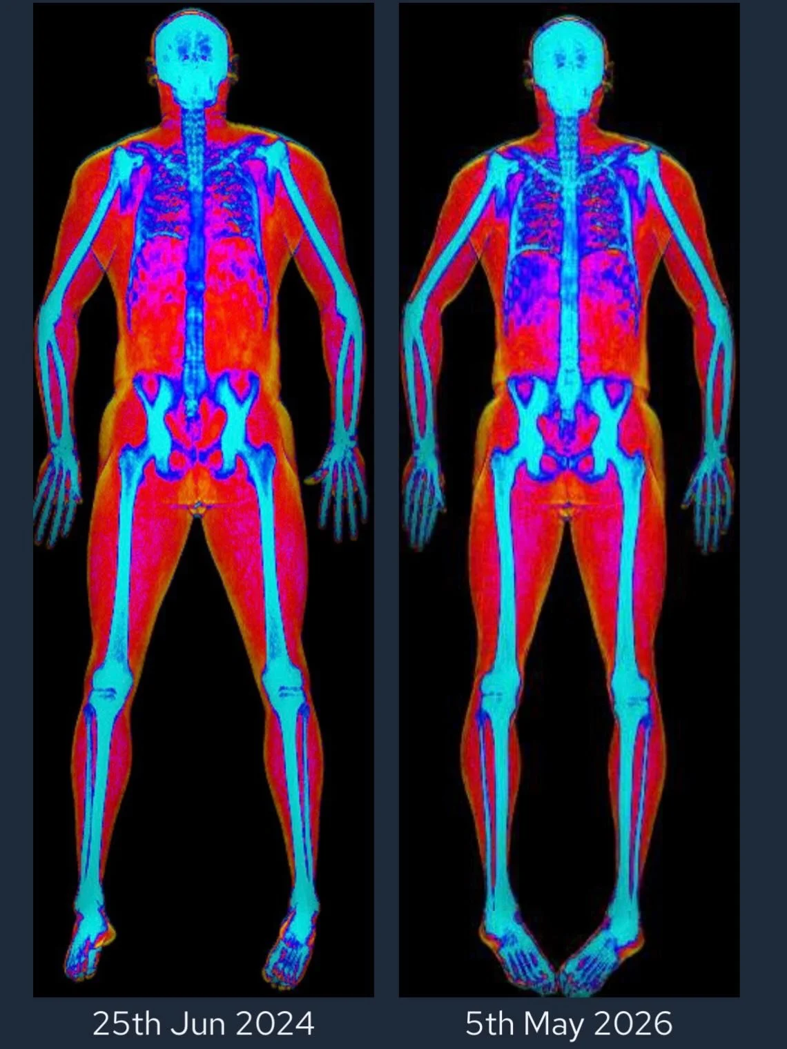 🥳 18.5% BODY FAT to 12.1% 🥳 

Really chuffed with the results of my latest DEXA scan today! A lot of hard work in and outside of the gym, strict dieting and giving up/drastically reducing things I love 😢
🍺🍰🍷🍕 

If you saw my post a couple year