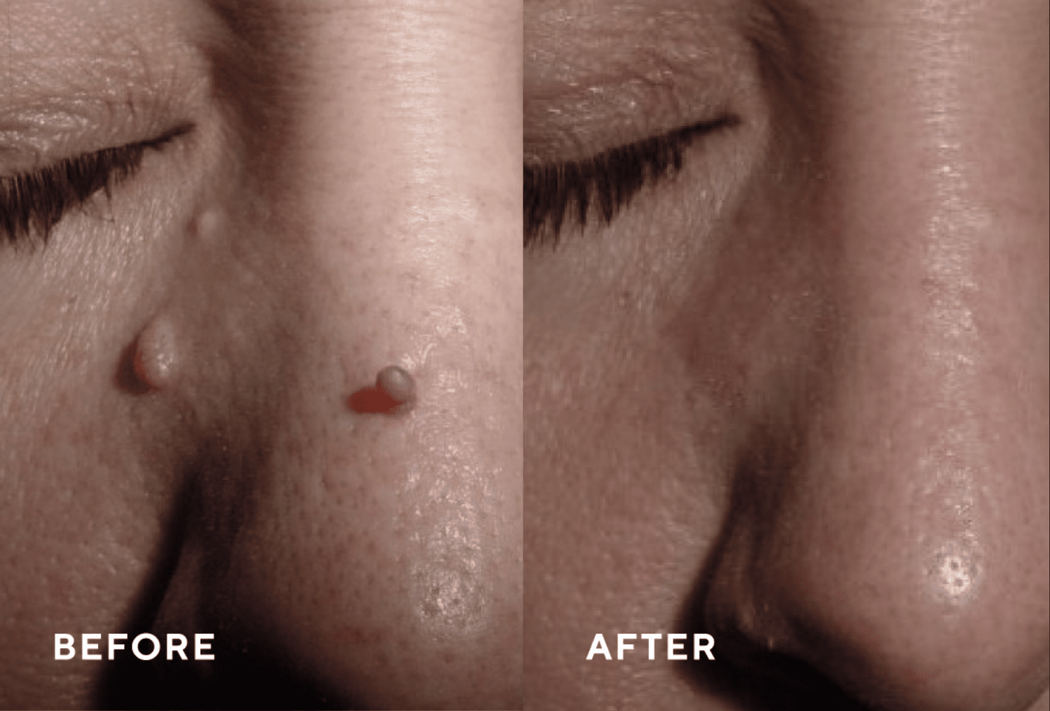 CryoPen pricing and results