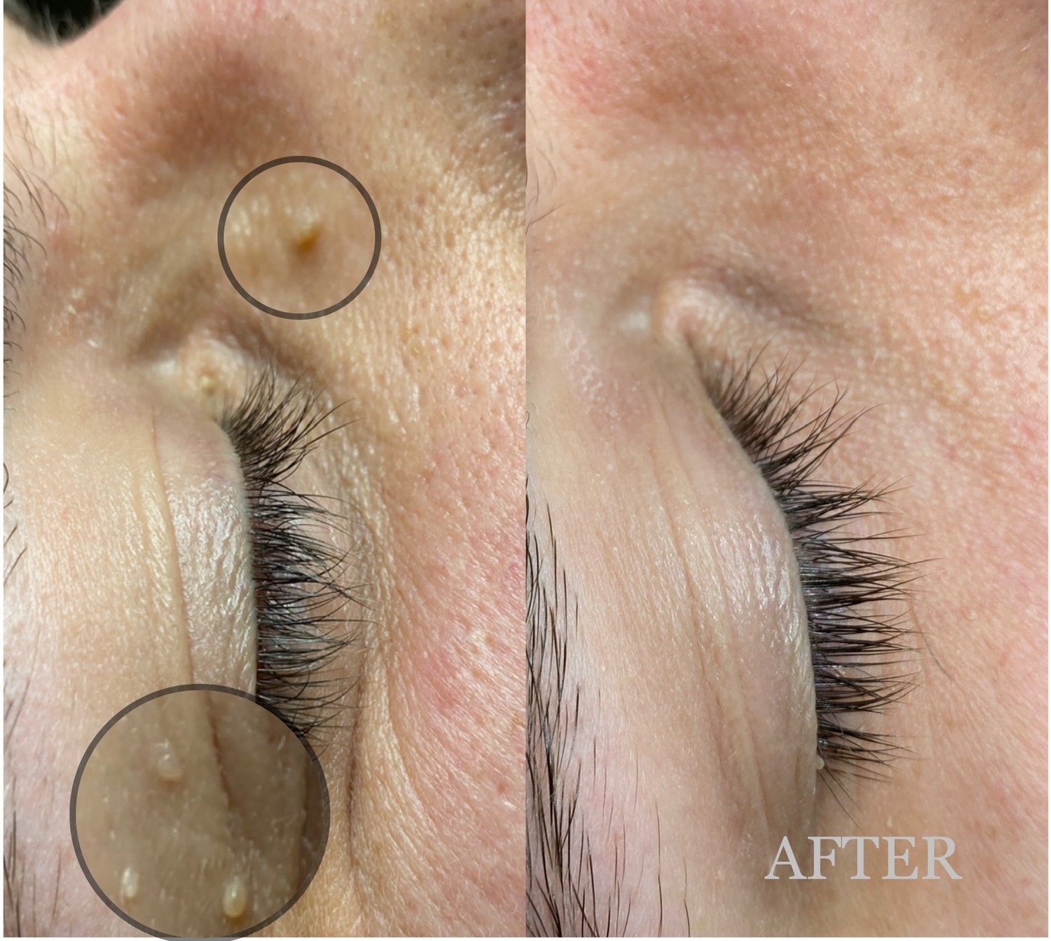 CryoPen cryotherapy before and after