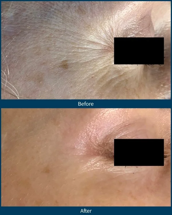 BA-SkinPen-FLAW-LG-CrowsFeet-ArizonaMicroneedling-5treatments-53YO.jpg