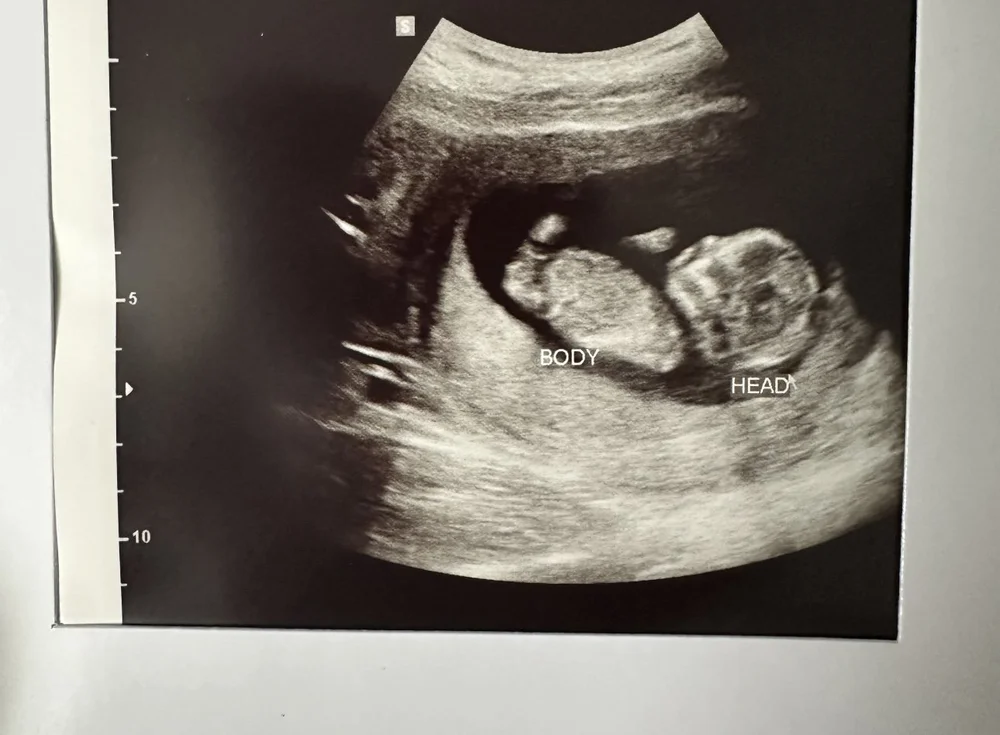 2ND ULTRASOUND