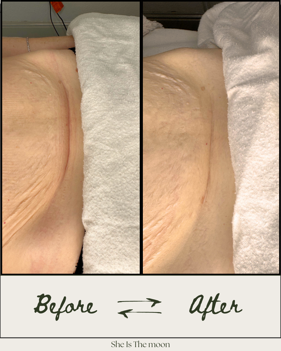 Comparison of skin on a person's back before and after treatment, with the words "Before" and "After" written below the two images. The skin appears smoother and less wrinkled in the "After" photo.
