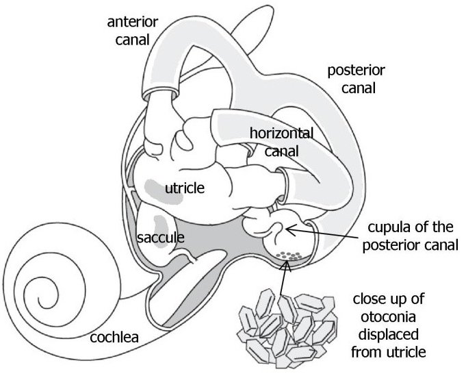Benign Paroxysmal Positional Vertigo (BPPV)