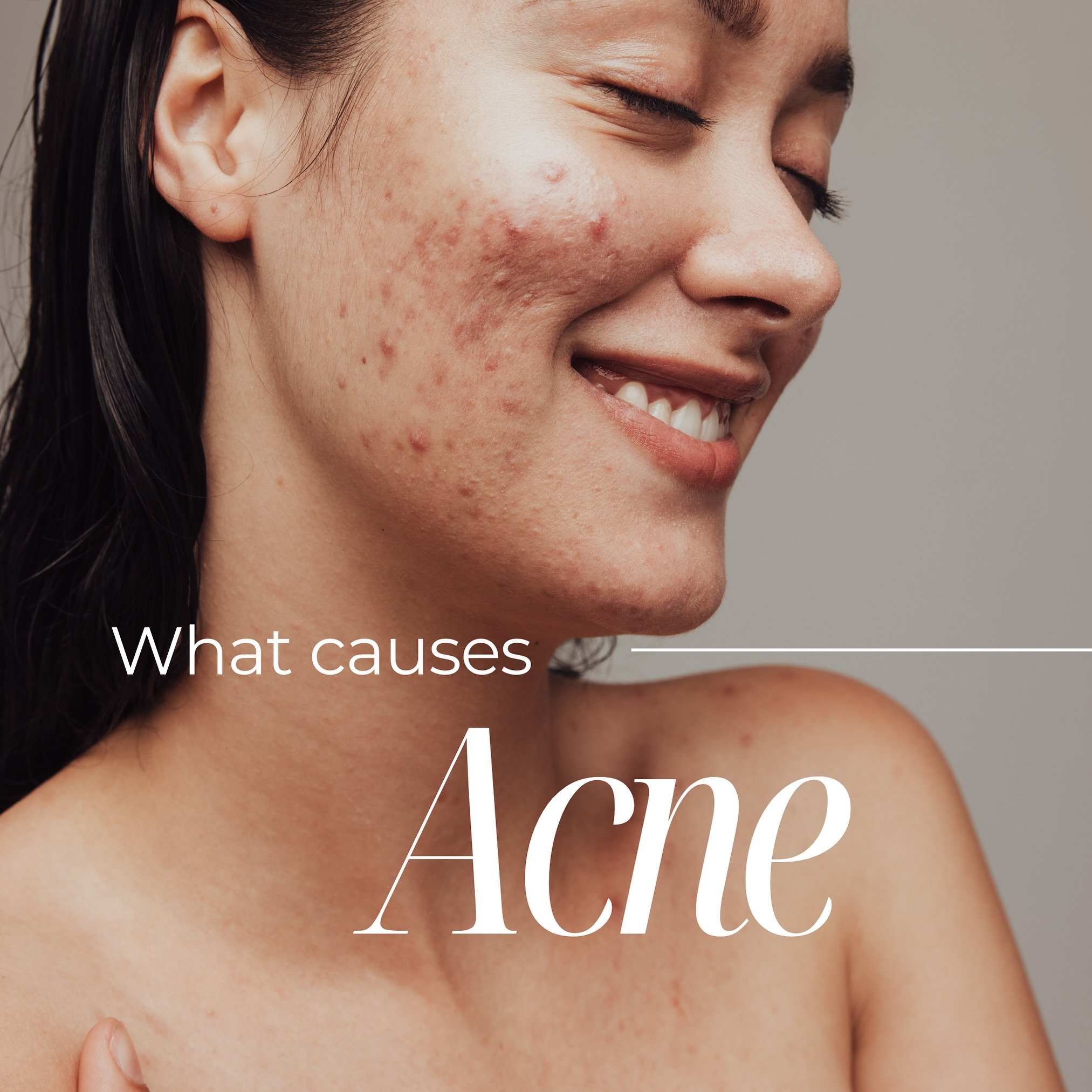 My first blog! ☺️ 

I thought I would write my first blog on Acne, this complex skin condition is easily one of the most common conditions clients seek treatment for. Over my years in the industry I have really delved into understanding the root caus