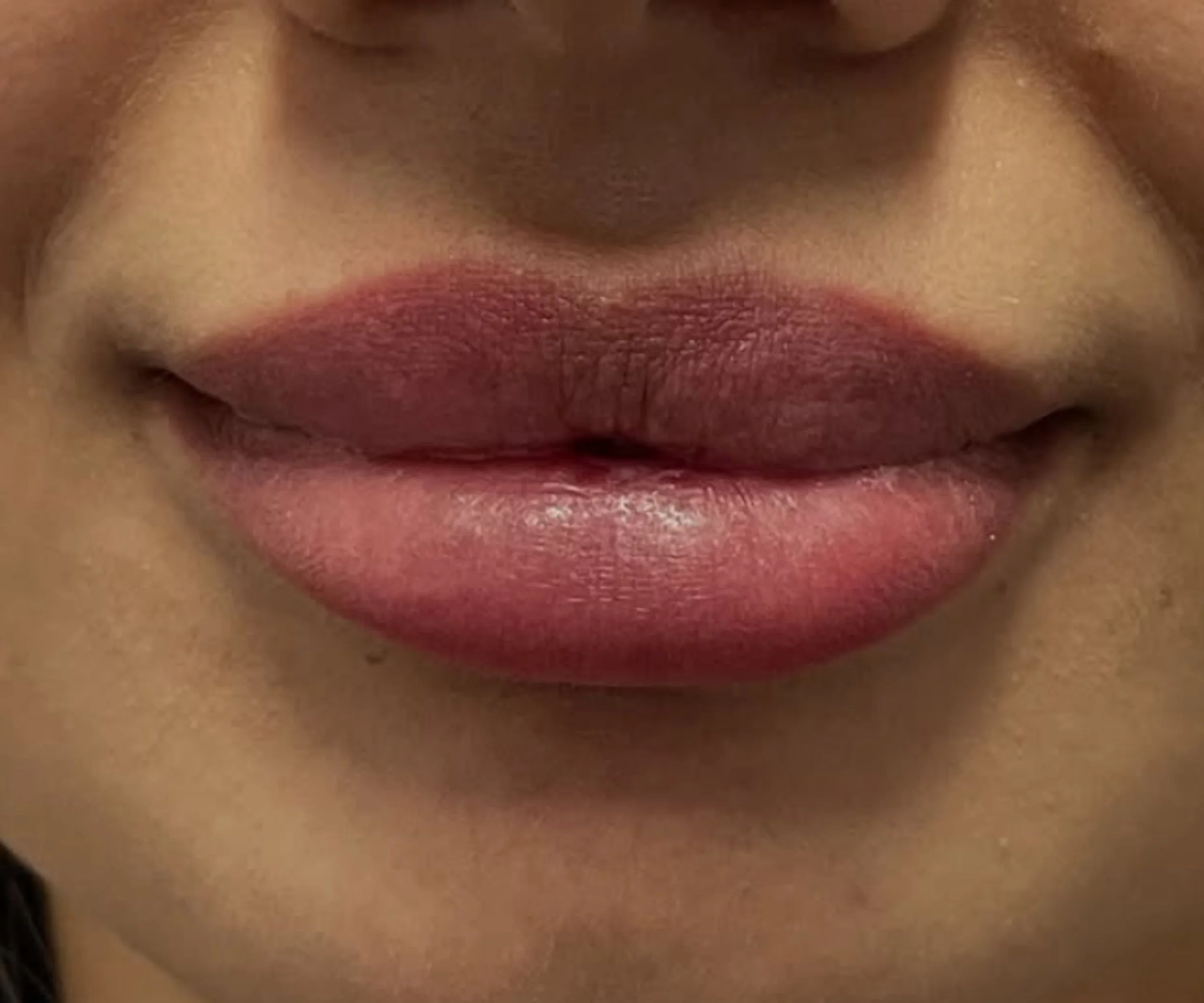 Rezultat natural după conturare buze cu filler premium Restylane