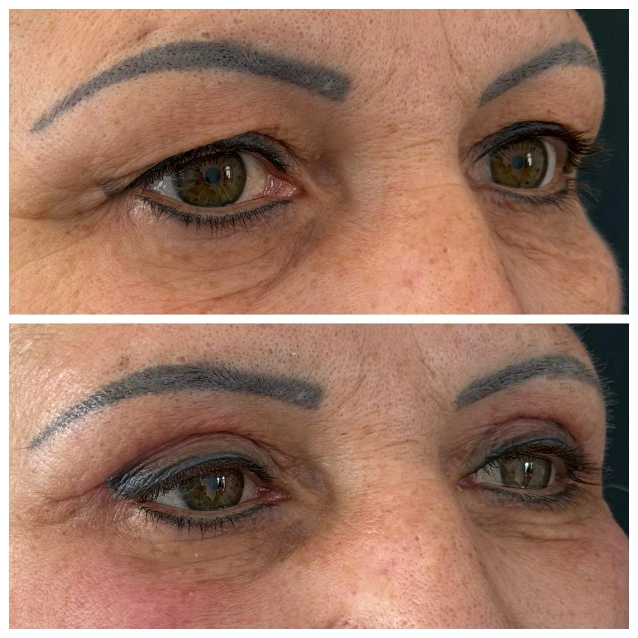 rezultat de blefaroplastie superioara imediat dupa suprimarea firelor de sutura