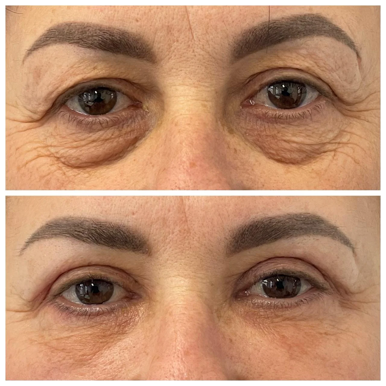 Vedere frontală înainte și după blefaroplastie superioară și inferioară transconjunctivală cu excizie de piele, laser CO2 și lipofilling