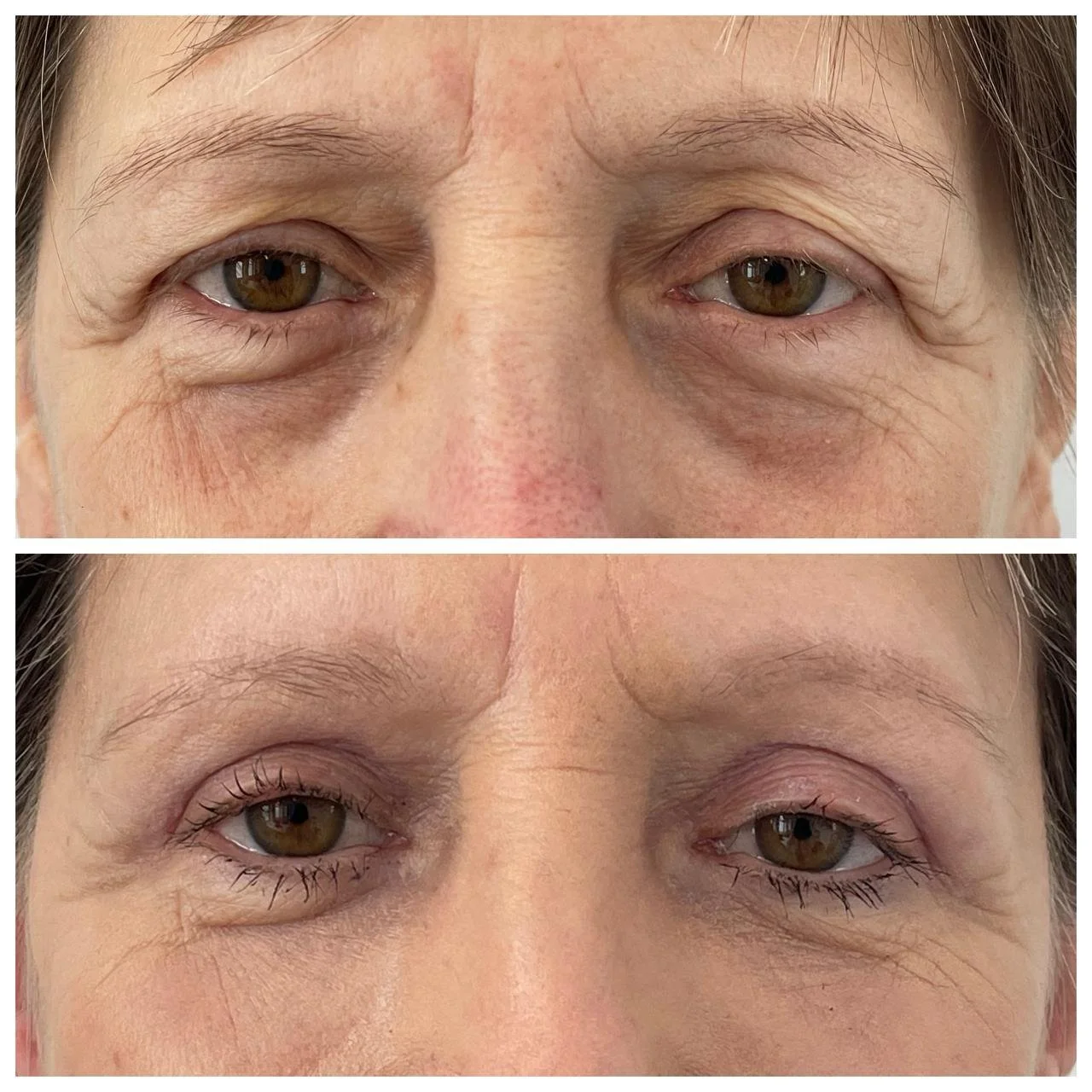 Vedere frontală înainte și la o lună după corecția pleoapei superioare cu lipofilling periocular