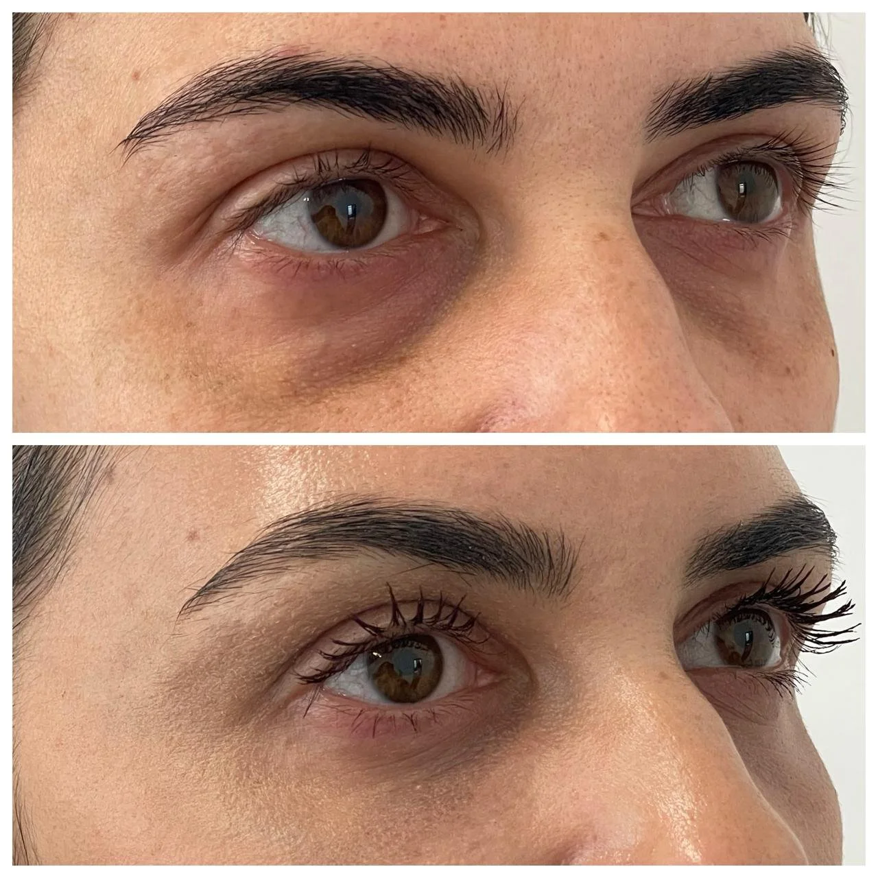 Aspectul zonei de sub ochi din semiprofil, la 4 zile după blefaroplastie inferioară transconjunctivală și lipofilling