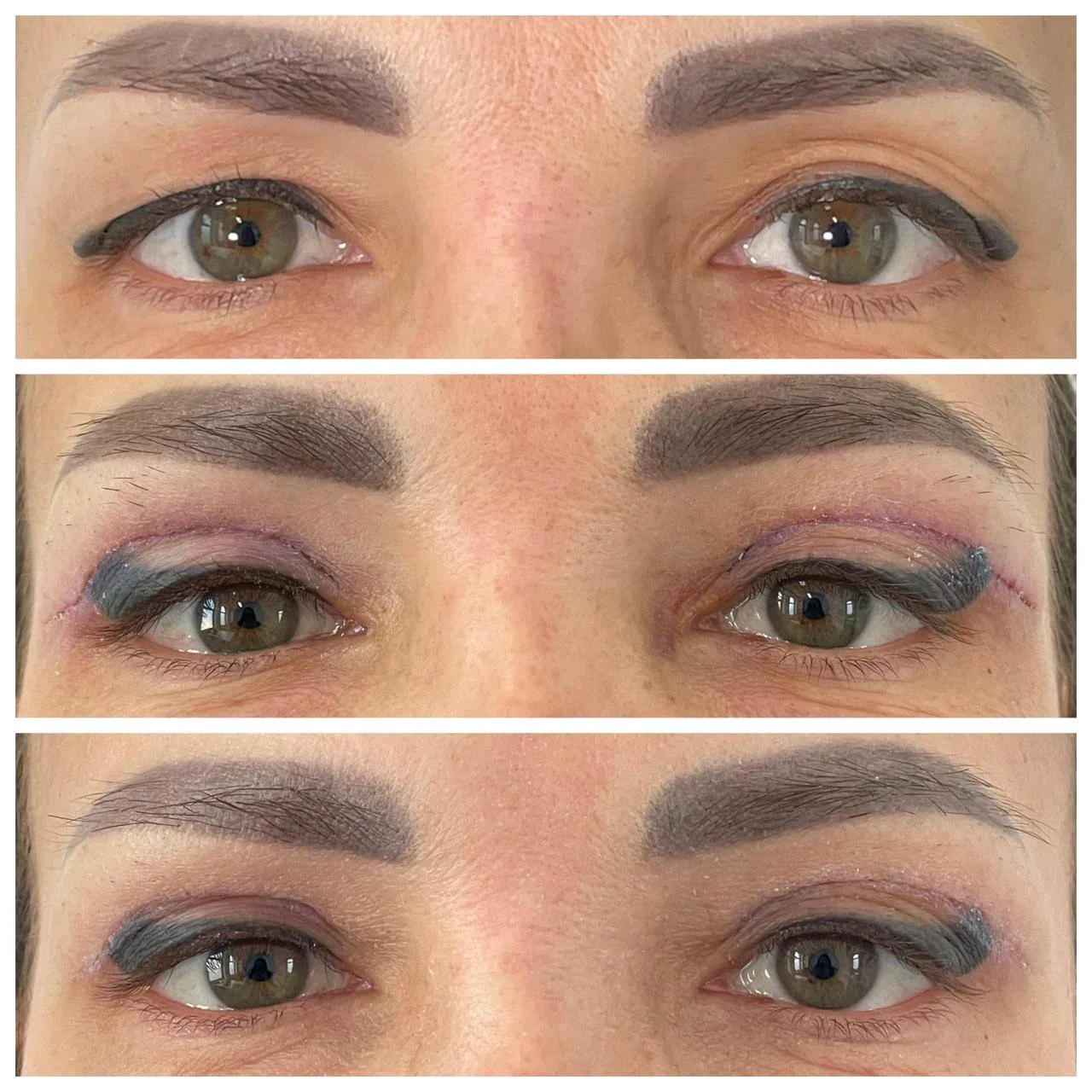 Evolutie postoperator Blefaroplastie superioara, preoperator, scoatem firele la 5 zile, rezultat 14 zile