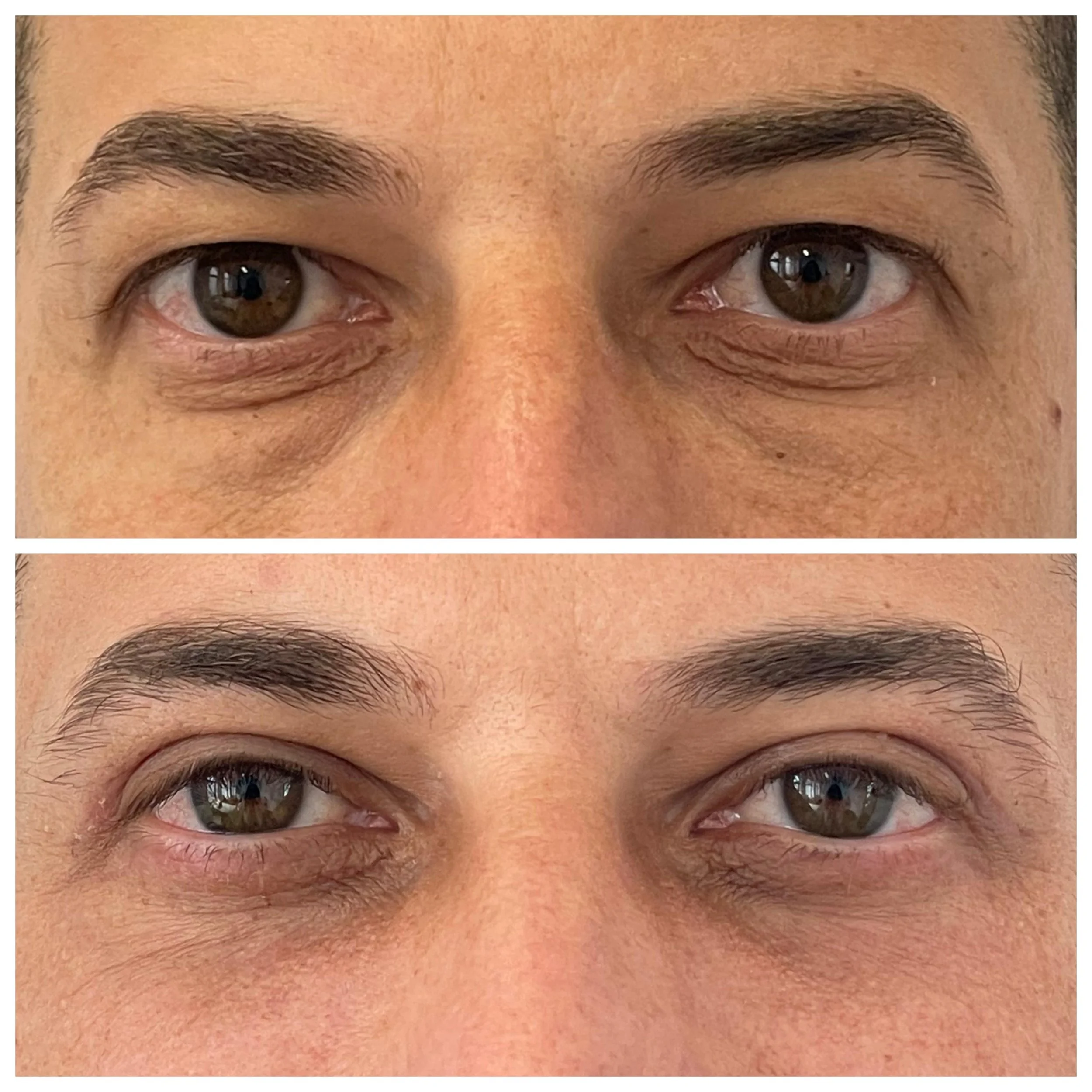 Belfaroplastia - Comparație înainte și după (vedere din față)