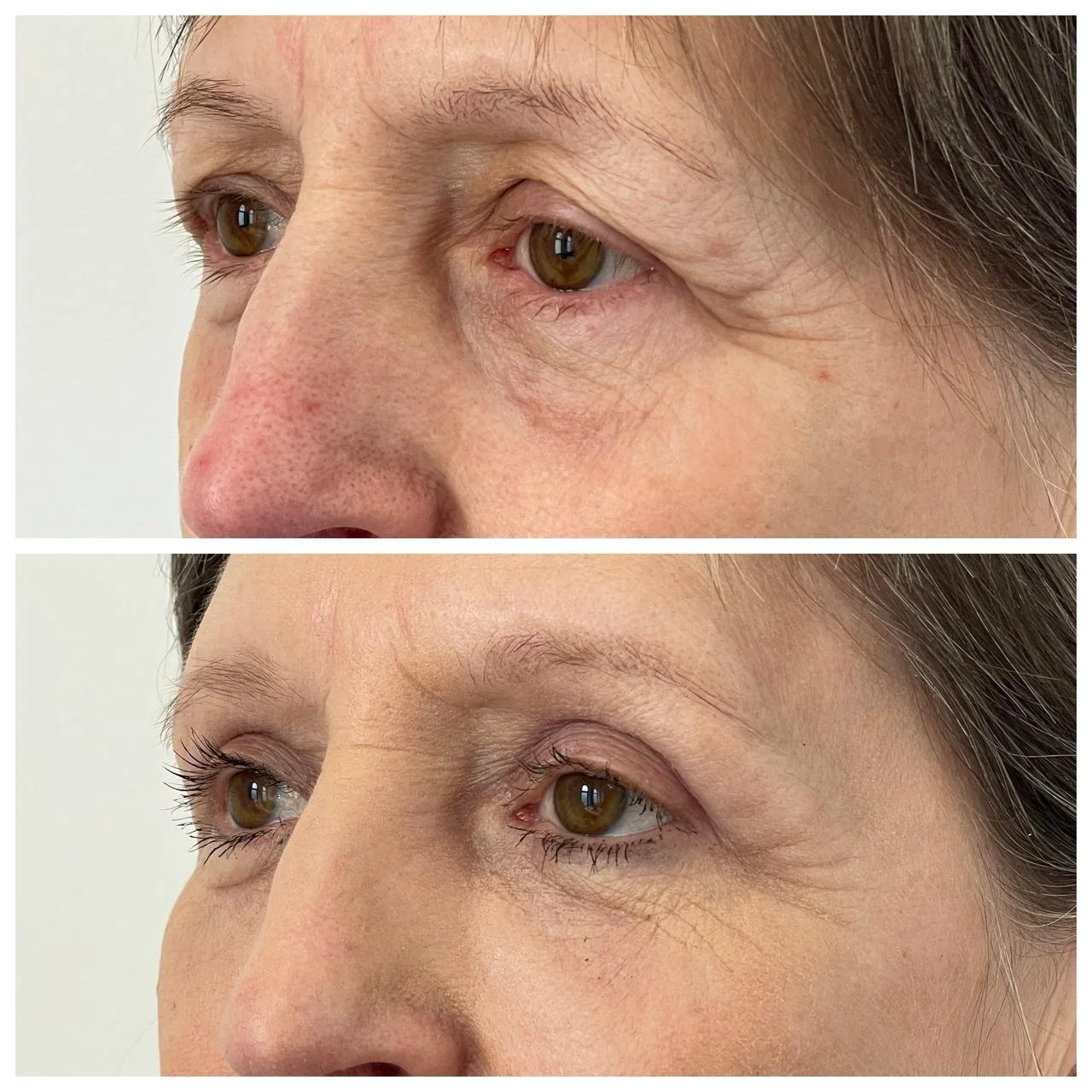 Vedere din semiprofil înainte și la o lună după blefaroplastie superioară cu lipofilling periocular