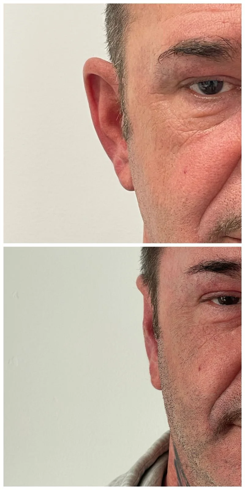 Rezultat după otoplastie – corectarea urechilor proeminente la Clinica ETIC