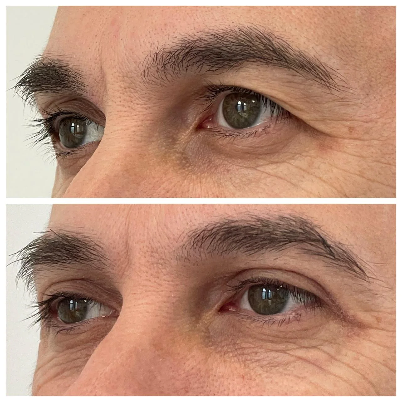 Vedere din semiprofil la 5 zile după blefaroplastie superioară, ca tratament conservator pentru excesul de piele al pleoapelor