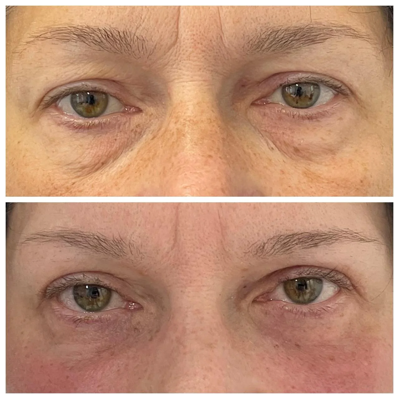 Vedere frontală la 2 săptămâni după blefaroplastie superioară secundară și blefaroplastie inferioară transconjunctivală, cu lipofilling periocular și laser CO2