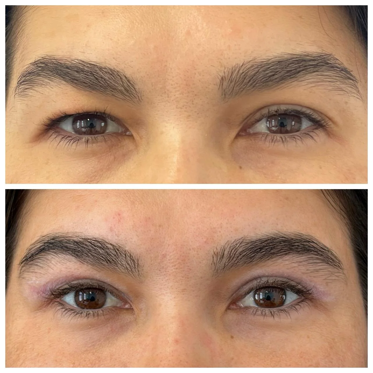 Vedere frontală înainte și la o lună după blefaroplastie superioară cu lipofilling periocular la nivelul pleoapei inferioare