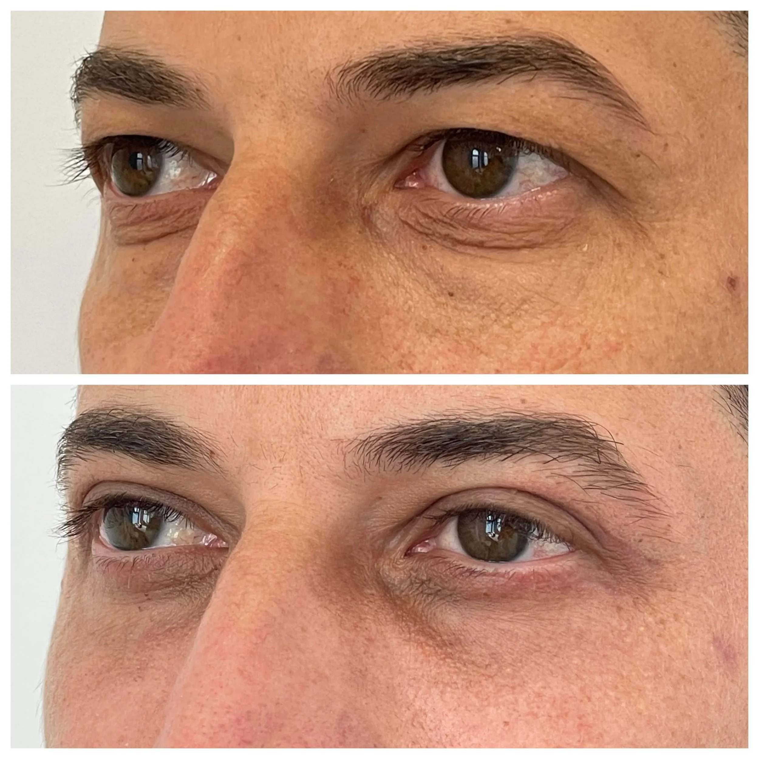 Befaloplastia - Comparație înainte și după (vedere din stânga)