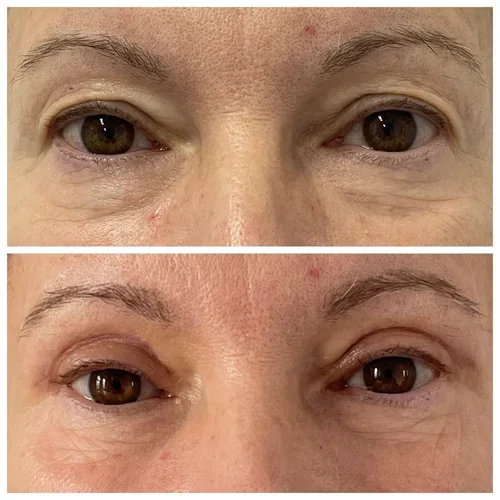 Pacient multumit dupa liftingul pleoapelor in judetul Hunedoara la Clinica Etic